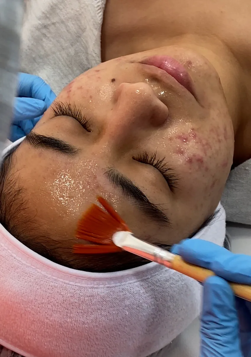 Peeling Químico